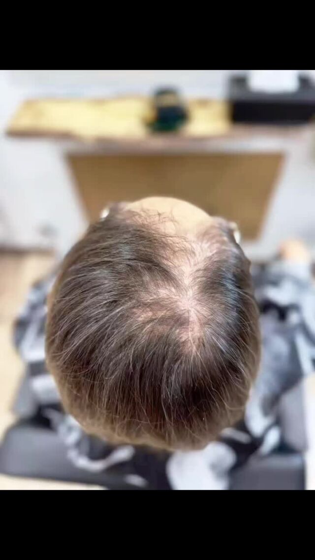 Hoy celebramos el increíble cambio de una de nuestras queridas clientas, quien confió en nosotros para dar un paso importante en su proceso personal. A través de un sistema capilar totalmente personalizado, logramos una transformación impecable que refleja no solo belleza exterior, sino también fuerza y confianza interior.Cada detalle fue pensado para ella: su estilo, su comodidad y su esencia. Y lo más importante, lo hicimos de la mano de un equipo profundamente empático, sensible y comprometido con el bienestar de cada persona que entra a nuestra Boutique.Gracias por permitirnos ser parte de tu camino. Porque en Kapilar, cada transformación es única.#TransformaciónKapilar#SistemaCapilar#CambioImpecable#ConfianzaRenovada#KapilarExperience#EmpatíaYEstilo#MadameJules#BoutiqueKapilar#KapilarByMadameJules. Pide tu cita ☎️ 604880203 📱.