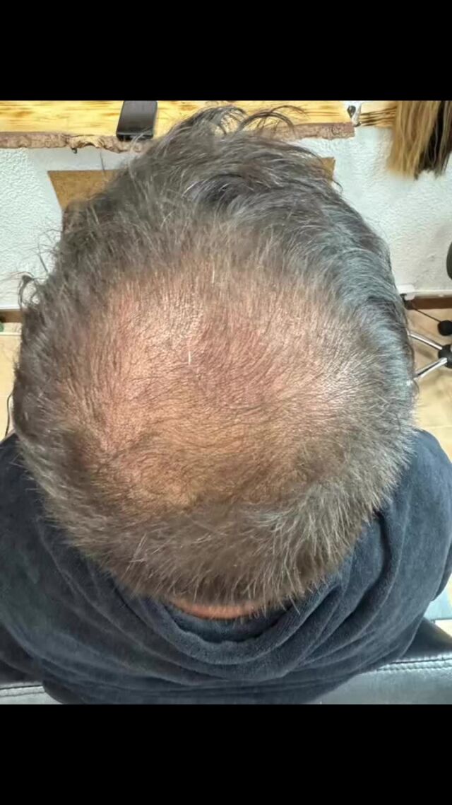 Transformación capilar a medida para un look impecable. Cada  cliente recibe una atención 100% personalizada. En este caso, diseñamos un sistema capilar exclusivo para un caballero que necesitaba cubrir solo una zona específica. ¿El resultado? Un acabado natural, elegante e indetectable. Solo trabajamos con sistemas capilares de alta calidad, y eso se nota en cada detalle. Porque la confianza también empieza el cabello. Reserva cita para tu diagnóstico personalizado aquí 👉www.kapilarbymadamejules.com/reservaso escríbenos por WhatsApp ☎️ 604880204 📱 #transformaciónkapilar#KapilarByMadameJules #TransformaciónCapilar #SistemasCapilares #SoluciónCapilar #CabelloNatural #EstiloPersonal #Confianza #HairSystem #MicropigmentaciónCapilar #HairTransformation #CuidadoCapilar #LookImpecable #CaballerosConEstilo
